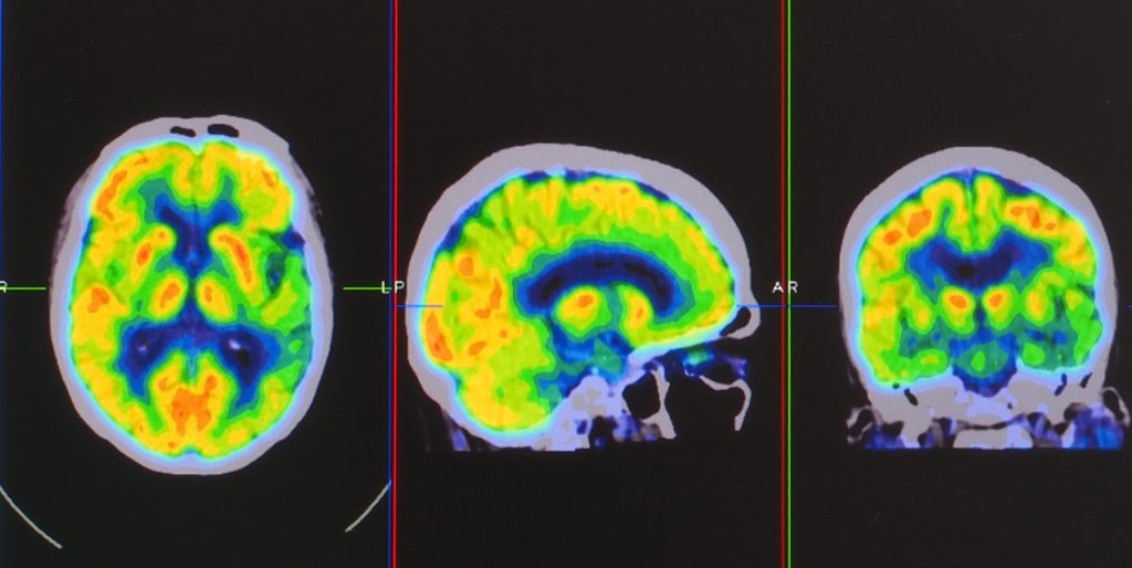 positron emission tomography